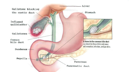 and sex gallstones