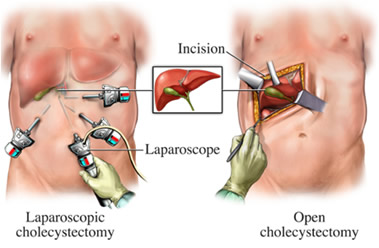 how long after turp surgery can i go back to work