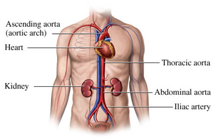 Abdominal Aortic Aneurysm Surgical Specialists Of Southwest Florida