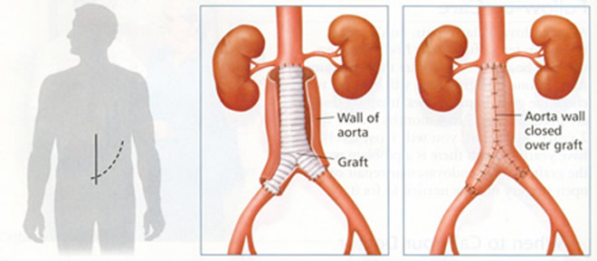 Abdominal Aortic Aneurysm Surgical Specialists Of Southwest Florida